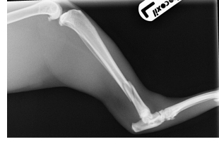Tibial Fracture